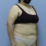 Bariatric Before & After Patient #1389