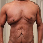 Post Bariatric Before & After Patient #1391