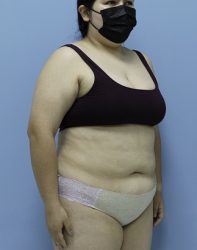 Bariatric Before & After Patient #1389