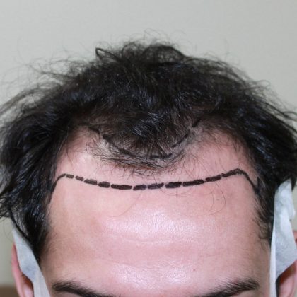 Hair Transplantation Before & After Patient #1418