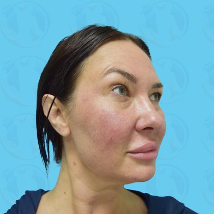 Cheek Lift Before & After Patient #1479