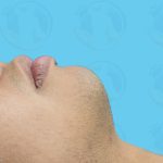 Chin Implant Before & After Patient #1486