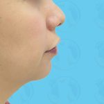 Chin Implant Before & After Patient #1487