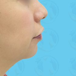 Chin Implant Before & After Patient #1487
