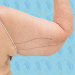 Brachioplasty Before & After Patient #889