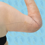 Brachioplasty Before & After Patient #889