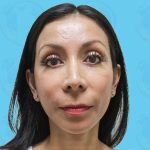 Rhinoplasty Before & After Patient #1439
