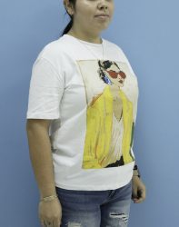 Bariatric Before & After Patient #1389