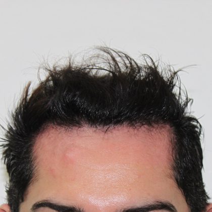 Hair Transplantation Before & After Patient #1418
