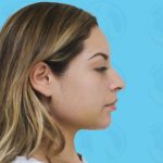 Chin Implant Before & After Patient #1484