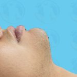 Chin Implant Before & After Patient #1486