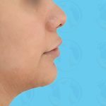Chin Implant Before & After Patient #1487
