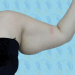 Brachioplasty Before & After Patient #890