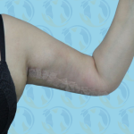 Brachioplasty Before & After Patient #890