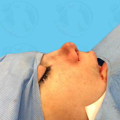 Rhinoplasty Before & After Patient #1447