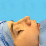 Rhinoplasty Before & After Patient #1447