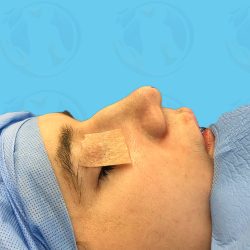 Rhinoplasty Before & After Patient #1447