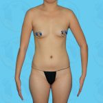 Breast Implant Before & After Patient #1542