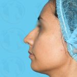 Rhinoplasty Before & After Patient #1444