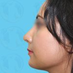 Rhinoplasty Before & After Patient #1444