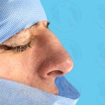 Rhinoplasty Before & After Patient #1446