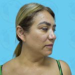 Facelift Before & After Patient #1499