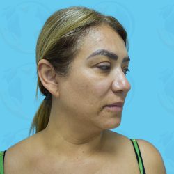 Facelift Before & After Patient #1499
