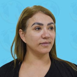 Facelift Before & After Patient #1499