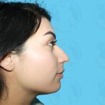 Rhinoplasty Before & After Patient #1442