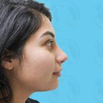 Rhinoplasty Before & After Patient #1442