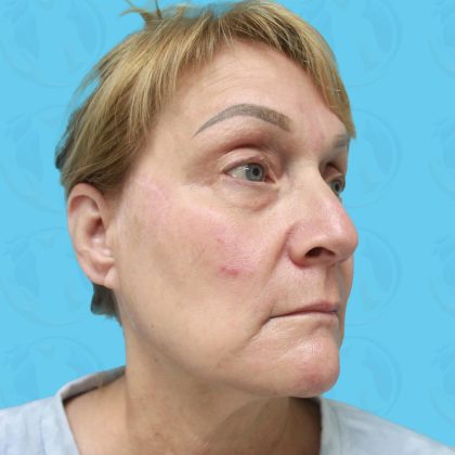 Facelift Before & After Patient #1502