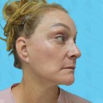 Facelift Before & After Patient #1502