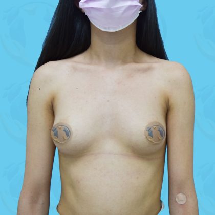 Breast Implant Before & After Patient #1547