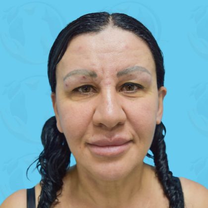 Facelift Before & After Patient #1498
