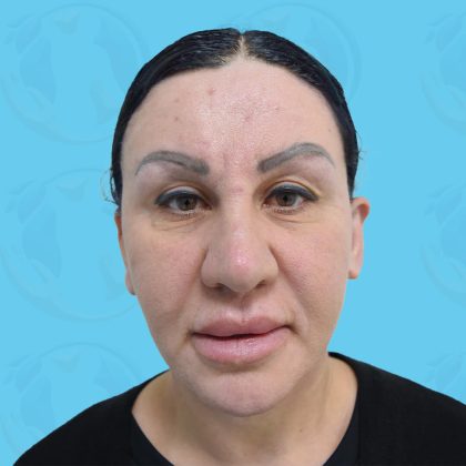 Facelift Before & After Patient #1498