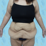 Post Bariatric Before & After Patient #1390