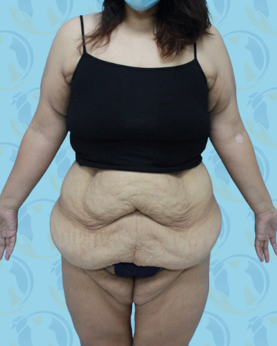 Post Bariatric Before & After Patient #1390