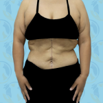 Post Bariatric Before & After Patient #1390