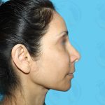 Rhinoplasty Before & After Patient #1440
