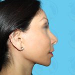 Rhinoplasty Before & After Patient #1440
