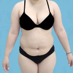 Breast Reduction Before & After Patient #1579