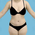 Breast Reduction Before & After Patient #1579