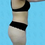Brazilian Butt Lift Before & After Patient #879