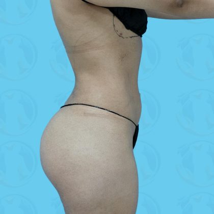 Brazilian Butt Lift Before & After Patient #879