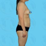 Tummy Tuck Before & After Patient #868