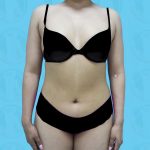 Tummy Tuck Before & After Patient #863
