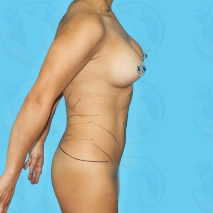 Liposuction Before & After Patient #844