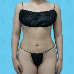 Tummy Tuck Before & After Patient #863