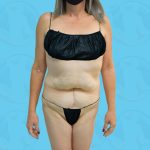 Liposuction Before & After Patient #840