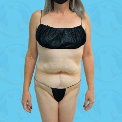 Liposuction Before & After Patient #840